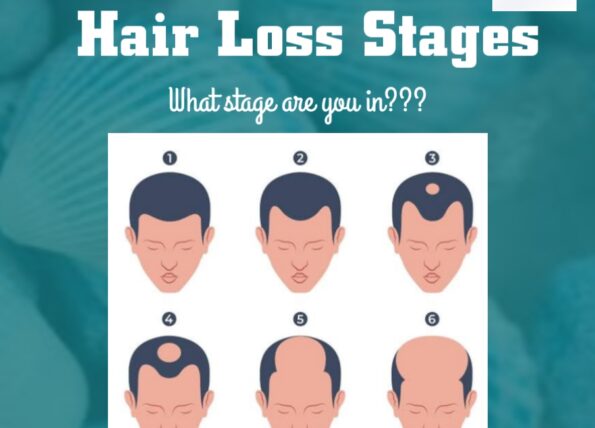 Hair Loss Stages What Stage Are You In